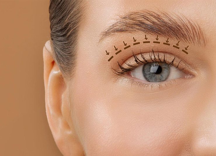 Μα πού εξαφανίστηκαν τα «κουκουλωτά» μάτια; Μήπως η χειρουργική επέμβαση είναι ο λόγος;