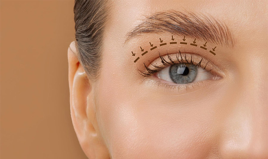 Μα πού εξαφανίστηκαν τα «κουκουλωτά» μάτια; Μήπως η χειρουργική επέμβαση είναι ο λόγος;