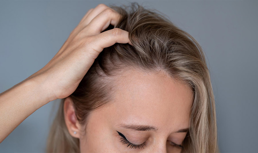 Το είδος τριχόπτωσης που επηρεάζει κυρίως τις μετεμμηνοπαυσιακές γυναίκες και εξελίσσεται… σε επιδημία